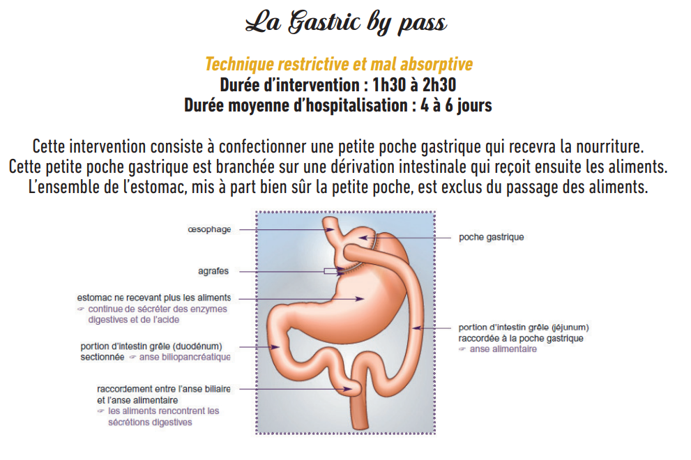 Schéma Chirurgie By pass.png